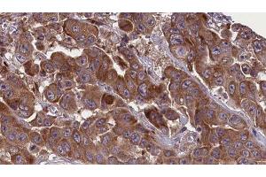ABIN6277630 at 1/100 staining Human liver cancer tissue by IHC-P.