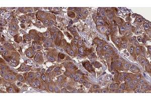 ABIN6277630 at 1/100 staining Human liver cancer tissue by IHC-P. (GNAS anticorps  (C-Term))
