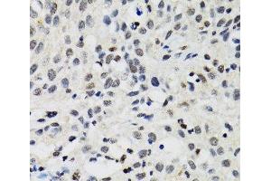 Immunohistochemistry of paraffin-embedded Human lung cancer using SMARCAD1 Polyclonal Antibody at dilution of 1:100 (40x lens). (SMARCAD1 anticorps)