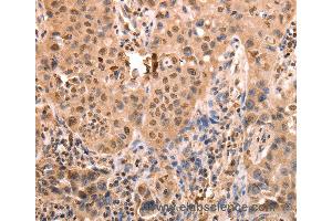Immunohistochemistry of Human lung cancer using ACO2 Polyclonal Antibody at dilution of 1:30 (ACO2 anticorps)