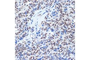 Immunohistochemistry of paraffin-embedded human thyroid cancer using RING1A Rabbit mAb (ABIN7270051) at dilution of 1:100 (40x lens). (RING1 anticorps)