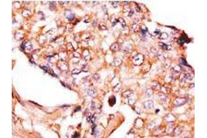 Formalin-fixed and paraffin-embedded human breast carcinoma reacted with anti-NP1 (Nptx1) Antibody (Center), which was peroxidase-conjugated to the secondary antibody, followed by DAB staining.