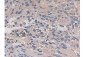 DAB staining on IHC-P; Samples: Human Lung cancer Tissue (Calpain 3 anticorps  (AA 602-821))
