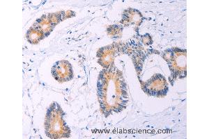 Immunohistochemistry of Human thyroid cancer using ADCY5 Polyclonal Antibody at dilution of 1:30 (ADCY5 anticorps)