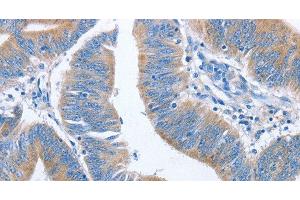 Immunohistochemistry of paraffin-embedded Human colon cancer using NCAPD2 Polyclonal Antibody at dilution of 1:40 (NCAPD2 anticorps)
