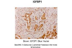 Sample Type :  Human lung adenocarcinoma  Primary Antibody Dilution :  1:300  Secondary Antibody :  Anti-rabbit-linker, Fbex-HRP  Secondary Antibody Dilution :  NOT FOUND  Color/Signal Descriptions :  Brown: IGFBP1 Blue: Nuclei  Gene Name :  IGF2BP1  Submitted by :  Haodong Xu. (IGF2BP1 anticorps  (N-Term))