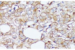 Immunohistochemistry of paraffin-embedded Human mammary cancer using SLC7A2 Polyclonal Antibody at dilution of 1:100 (40x lens). (SLC7A2 anticorps)