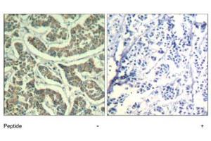 Immunohistochemical analysis of paraffin-embedded human breast carcinoma tissue using ATR polyclonal antibody . (ATR anticorps  (Ser428))