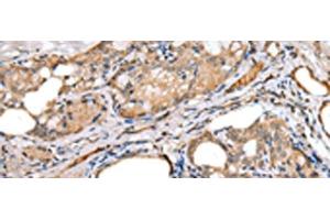 Immunohistochemistry of paraffin-embedded Human thyroid cancer tissue using LRRC19 Polyclonal Antibody at dilution of 1:30(x200) (LRRC19 anticorps)