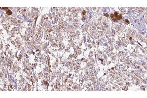 ABIN6275310 at 1/100 staining Human Melanoma tissue by IHC-P. (VGF anticorps  (Internal Region))