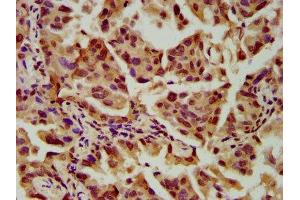 IHC image of ABIN7169791 diluted at 1:600 and staining in paraffin-embedded human lung cancer performed on a Leica BondTM system. (SLC2A4RG anticorps  (AA 1-100))