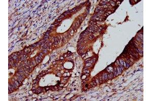 IHC image of ABIN7166237 diluted at 1:200 and staining in paraffin-embedded human colon cancer performed on a Leica BondTM system.