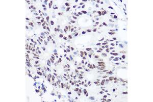 Immunohistochemistry of paraffin-embedded human colon carcinoma using S Rabbit pAb (ABIN6128698, ABIN6147392, ABIN6147393 and ABIN6215703) at dilution of 1:100 (40x lens). (SART3 anticorps  (AA 664-963))