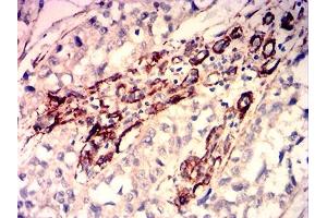 Immunohistochemical analysis of paraffin-embedded bladder cancer tissues using CALD1 mouse mAb with DAB staining.