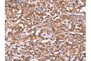 The image on the left is immunohistochemistry of paraffin-embedded Human thyroid cancer tissue using ABIN7190999(HRASLS2 Antibody) at dilution 1/20, on the right is treated with synthetic peptide. (HRASLS2 anticorps)