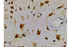 ABIN6277691 at 1/200 staining human cholangiocarcinoma tissue sections by IHC-P. (Ephrin B2 anticorps  (C-Term))