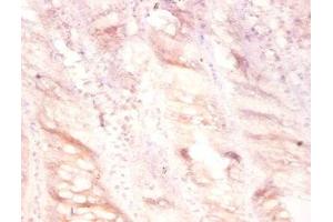 Immunohistochemistry of paraffin-embedded human colon cancer using ABIN7175129 at dilution of 1:100