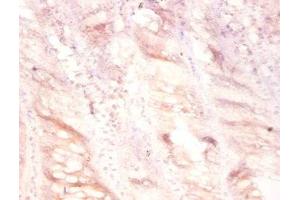 Immunohistochemistry of paraffin-embedded human colon cancer using ABIN7175129 at dilution of 1:100 (PLAU anticorps  (AA 21-173))
