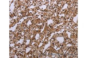 Immunohistochemistry of Human esophagus cancer using MEIS1 Polyclonal Antibody at dilution of 1:40 (MEIS1 anticorps)