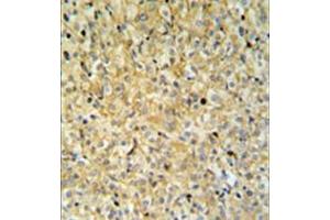 Immunohistochemistry analysis in formalin fixed and paraffin embedded kidney carcinoma reacted with MAPK1IP1L Antibody (Center) followed which was peroxidase conjugated to the secondary antibody and followed by DAB staining. (MAPK1IP1L anticorps  (C-Term, Middle Region))