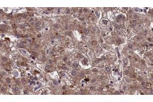 ABIN6273965 at 1/100 staining Human liver cancer tissue by IHC-P. (OR10Q1 anticorps  (C-Term))