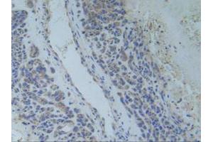 IHC-P analysis of Human Lung Cancer Tissue, with DAB staining. (TNFRSF1A anticorps  (AA 248-428))