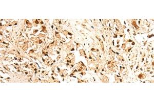 Immunohistochemistry of paraffin-embedded Human prost ate cancer tissue using JPT2 Polyclonal Antibody at dilution of 1:65(x200) (JPT2 anticorps)