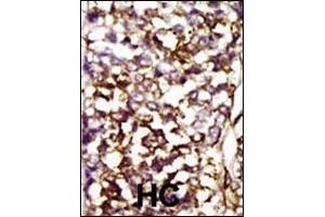Formalin-fixed and paraffin-embedded human cancer tissue reacted with the primary antibody, which was peroxidase-conjugated to the secondary antibody, followed by AEC staining.