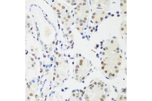Immunohistochemistry of paraffin-embedded human gastric cancer using MECP2 antibody. (MECP2 anticorps)