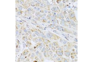 Immunohistochemistry of paraffin-embedded human esophageal cancer using LYZ antibody (ABIN5975352) at dilution of 1/100 (40x lens).