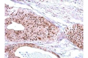 IHC-P Image Immunohistochemical analysis of paraffin-embedded human gastric cancer, using RFC3, antibody at 1:500 dilution. (RFC3 anticorps)