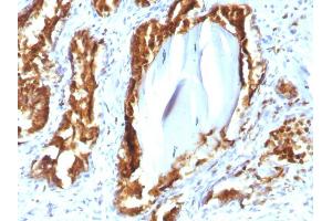 Formalin-fixed, paraffin-embedded human Prostate Carcinoma stained with PSAP Mouse Recombinant Monoclonal Antibody (rACPP/1338). (Recombinant ACPP anticorps)