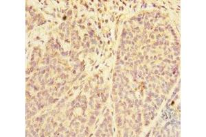 Immunohistochemistry of paraffin-embedded human ovarian cancer using ABIN7168416 at dilution of 1:100 (PDE6A anticorps  (AA 656-860))