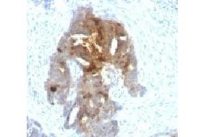 IHC testing of human ovarian carcinoma with TAG-72 antibody.