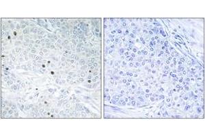 Immunohistochemistry analysis of paraffin-embedded human breast carcinoma tissue, using TP53INP2 Antibody.