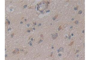 Detection of NFkB in Human Glioma Tissue using Polyclonal Antibody to Nuclear Factor Kappa B (NFkB)