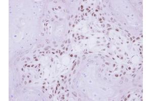 IHC-P Image Immunohistochemical analysis of paraffin-embedded Ca922 Xenograft, using IP6K1, antibody at 1:500 dilution.