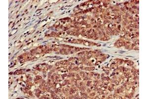 Immunohistochemistry of paraffin-embedded human ovarian cancer using ABIN7168699 at dilution of 1:100