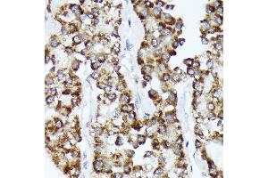 Immunohistochemistry of paraffin-embedded human liver cancer using CDC Rabbit mAb (ABIN7266261) at dilution of 1:100 (40x lens). (CDCA3 anticorps)