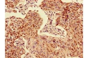 Immunohistochemistry of paraffin-embedded human cervical cancer using ABIN7143262 at dilution of 1:100