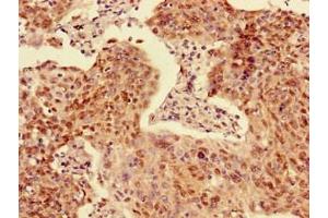 Immunohistochemistry of paraffin-embedded human cervical cancer using ABIN7143262 at dilution of 1:100 (Acyp2 anticorps  (AA 28-87))