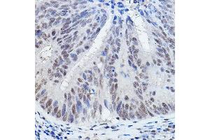 Immunohistochemistry of paraffin-embedded human colon carcinoma using DGCR8 Rabbit pAb (ABIN7266761) at dilution of 1:200 (40x lens).