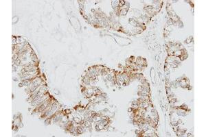 IHC-P Image Immunohistochemical analysis of paraffin-embedded OVCA xenograft, using GPR164, antibody at 1:100 dilution. (OR51E1 anticorps)