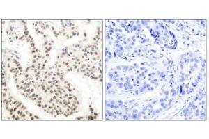 Immunohistochemical analysis of paraffin-embedded human breast carcinoma tissue using Elk-1 (phospho-Thr417) antibody. (ELK1 anticorps  (pThr417))