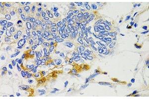 Immunohistochemistry of paraffin-embedded Human gastric cancer using PTPN11 Polyclonal Antibody at dilution of 1:100 (40x lens). (PTPN11 anticorps)