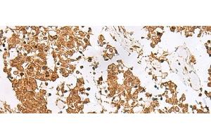 Immunohistochemistry of paraffin-embedded Human lung cancer tissue using SCRN2 Polyclonal Antibody at dilution of 1:60(x200)