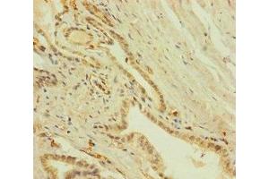 Immunohistochemistry of paraffin-embedded human prostate cancer using ABIN7151756 at dilution of 1:100 (ZNF71 anticorps  (AA 101-300))
