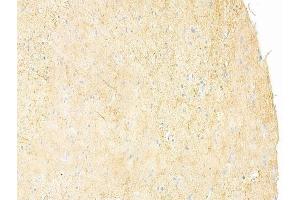 ABIN6261669 and ABIN6273242 at 1/100 staining human glioblastoma by IHC-P. (FAM65B anticorps  (Internal Region))