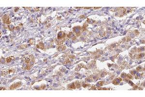 ABIN6272580 at 1/100 staining Human liver cancer tissue by IHC-P. (GRIK5 anticorps  (Internal Region))