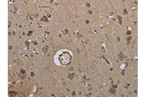 The image on the left is immunohistochemistry of paraffin-embedded Human brain tissue using ABIN7191406(MARK4 Antibody) at dilution 1/40, on the right is treated with synthetic peptide.